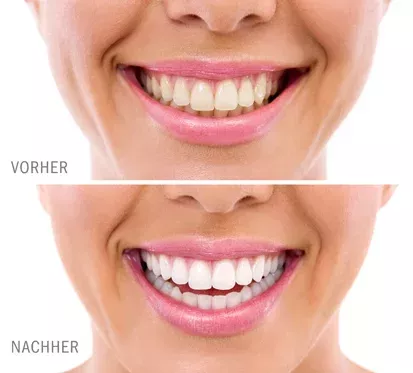 Vorher-Nachher-Bild vom Bleaching beim Zahnarzt